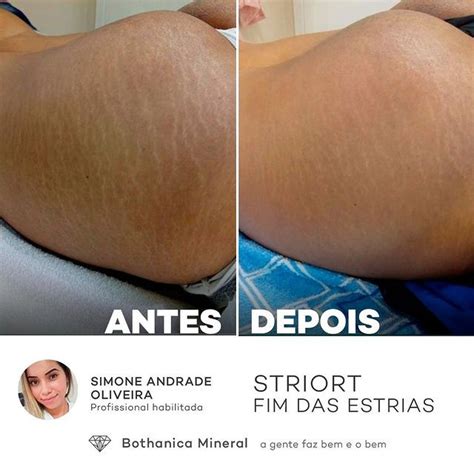 striort antes e depois